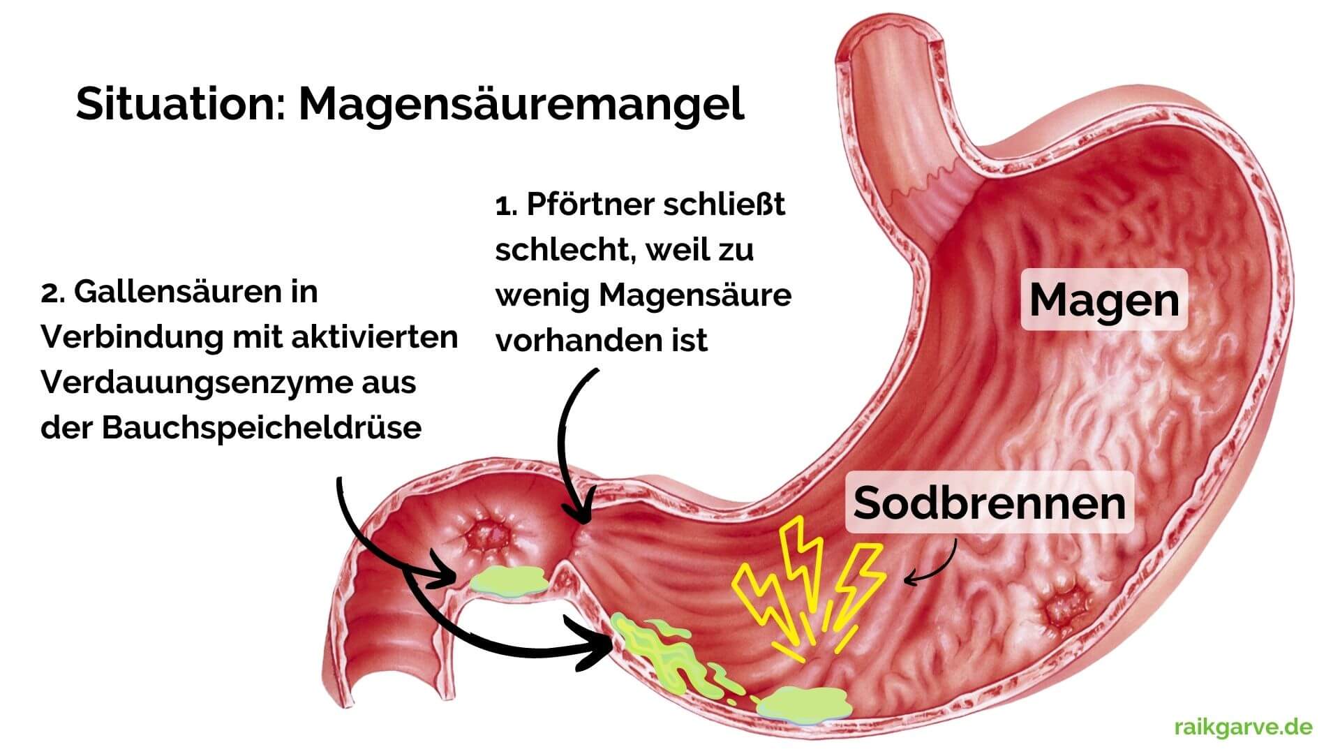 Die Ursache von Sodbrennen durch zu wenig Magensäure erklärt mit Schaubild Die Ursache von Sodbrennen durch zu wenig Magensäure erklärt mit Schaubild